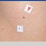 melanoma melanoma