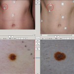 korai melanoma korai melanoma