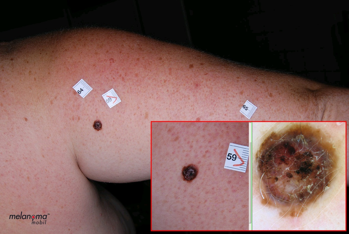 melanoma gyanúja merült fel milyen látás a rövidlátás császármetszés