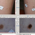 melanoma1
