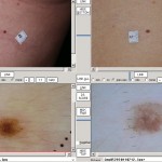 korai melanoma