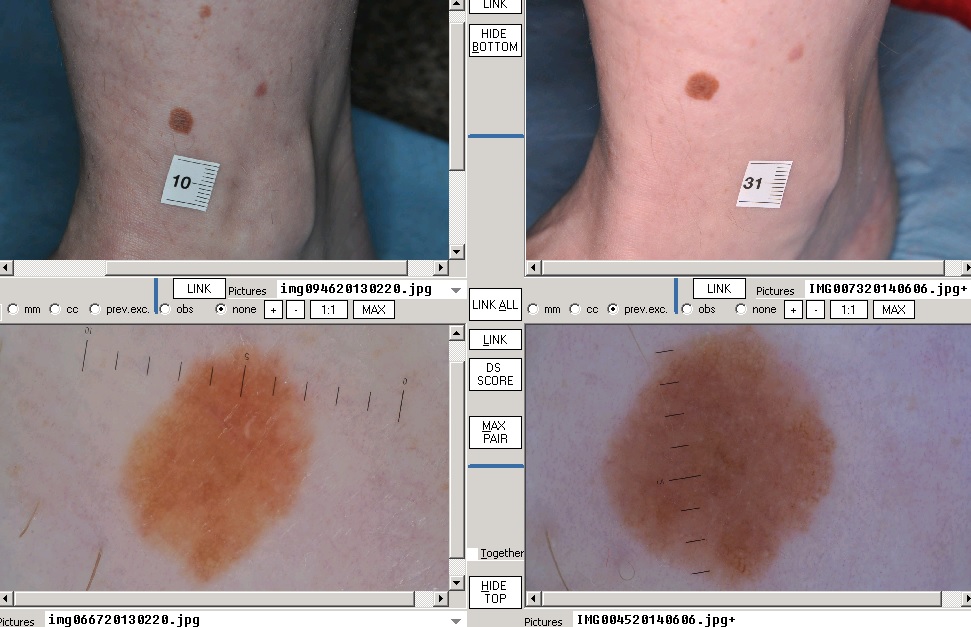 Melanoma gyanúja merre menjen. Májrák, májáttét | Rákgyógyítás