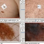melanoma_kep