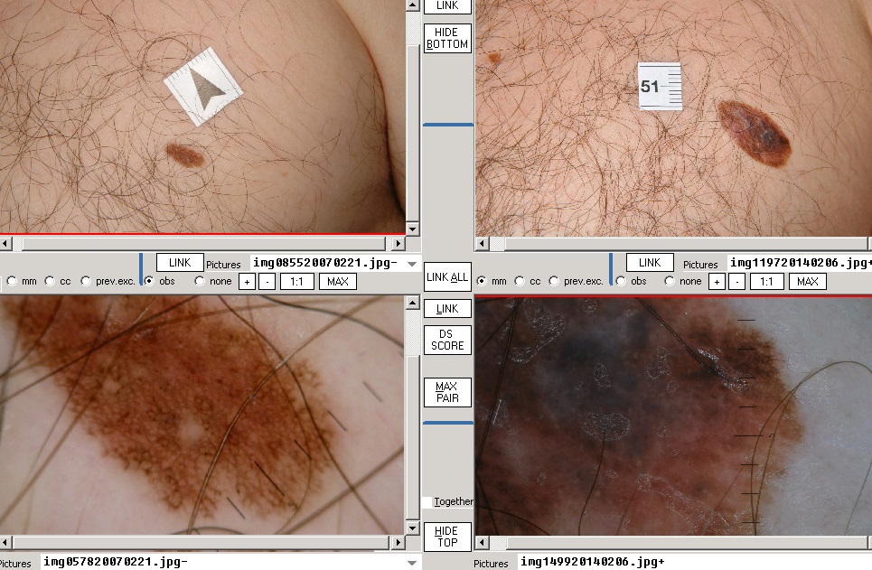 A kezdeti stádiumú bőrrák: tünetek, jelek, fényképek - Megelőzés 