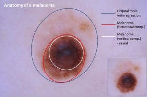 A melanoma anatómiája